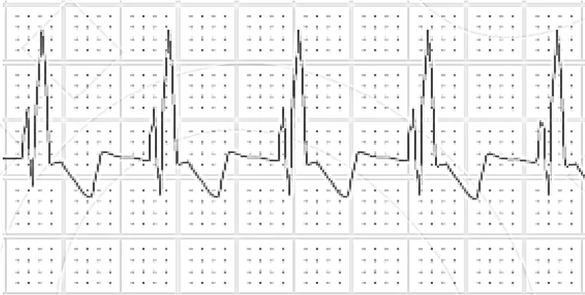 Aşağıdaki elektrokardiyografi görüntülerinin hangisinde erken defibrilasyon endikasyonu vardır?